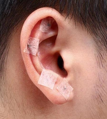 Akupunktur Kulak İğnesi 0.22*1.3 MM