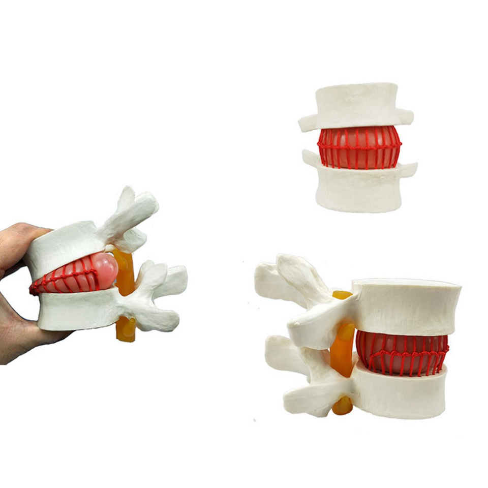 Disk Hernisi Fıtık Maketi Model 2